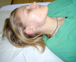 Acne del viso_Prima