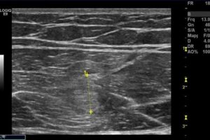 Lesione muscolare distrattiva_16_12_2011