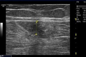 Lesione muscolare distrattiva_22_11_2011